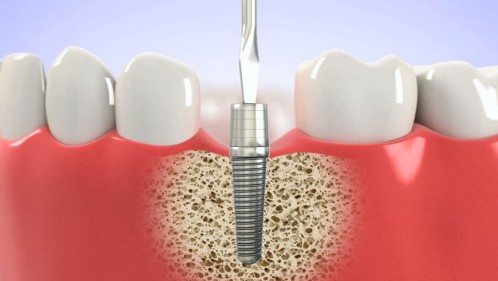 Trồng răng Implant - Công nghệ mới giúp khắc phục răng mất, khôi phục chức  năng ăn nhai