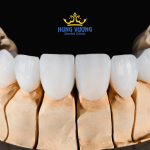 Hình ảnh các mặt dán sứ veneer tương ứng với từng răng